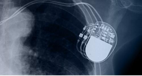 Cardiac Rhythm Management Devices